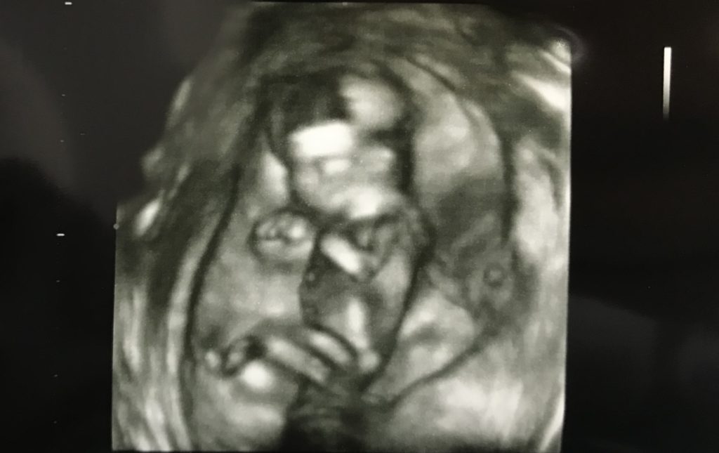 妊娠12週　赤ちゃん　4Dエコー写真