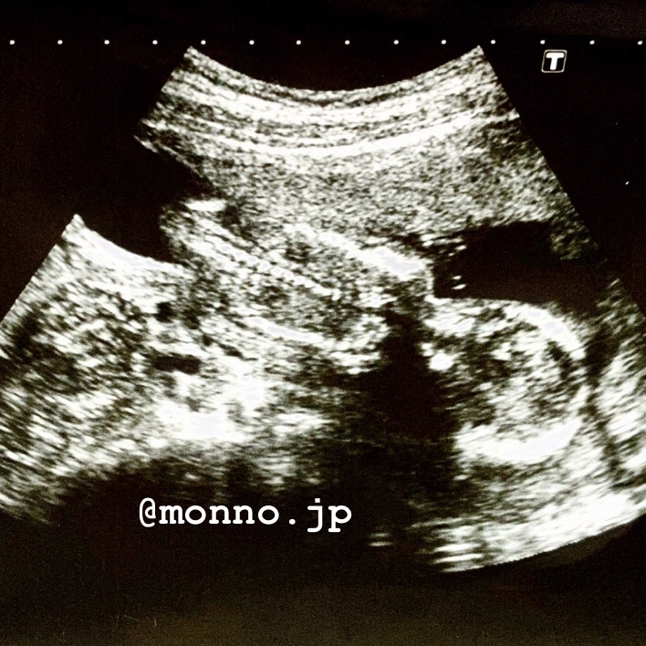 妊娠15週　赤ちゃん　胎児　エコー写真