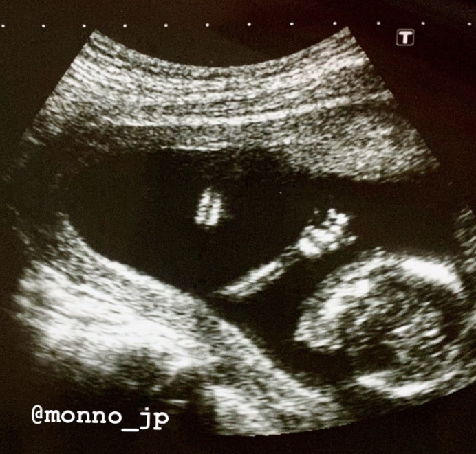 妊娠15週　赤ちゃん　胎児　エコー写真